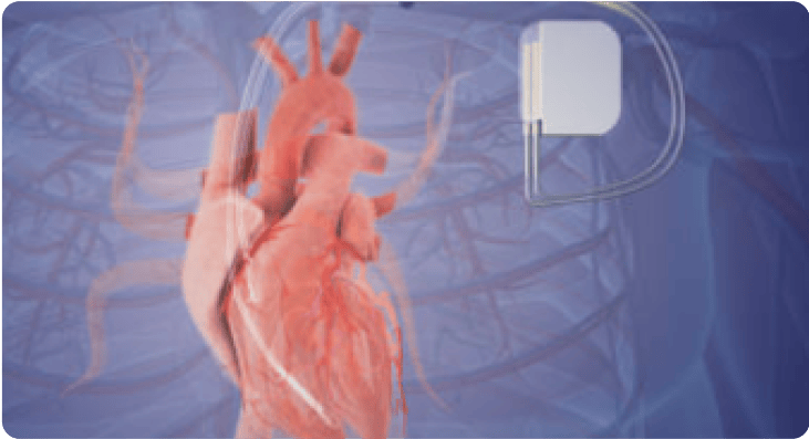 Left Bundle Branch Pacemaker - Advanced Cardiac Device